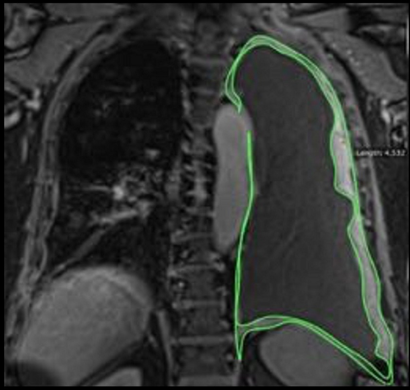 MRI scan showing MPM tumour highlighted in green